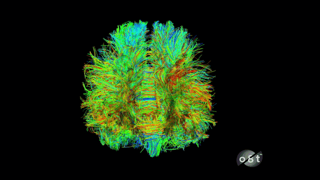 Tractographic view of the brain
